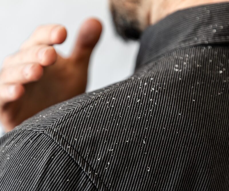 How can you tell if you have seborrheic dermatitis or another skin condition?