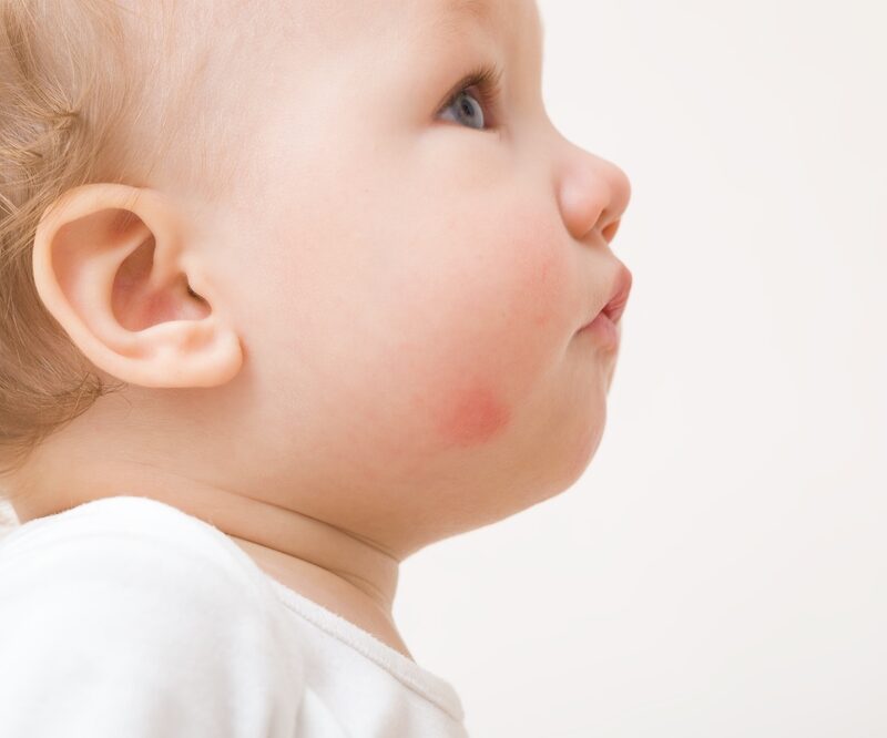 Baby Acne vs. Eczema: How can parents tell them apart?