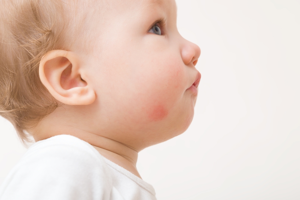 Baby Acne vs. Eczema: How can parents tell them apart?
