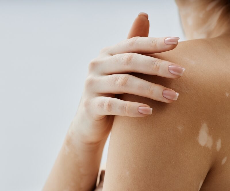 Is Vitiligo an autoimmune disease or a skin condition? Expert Dermatologist Explains