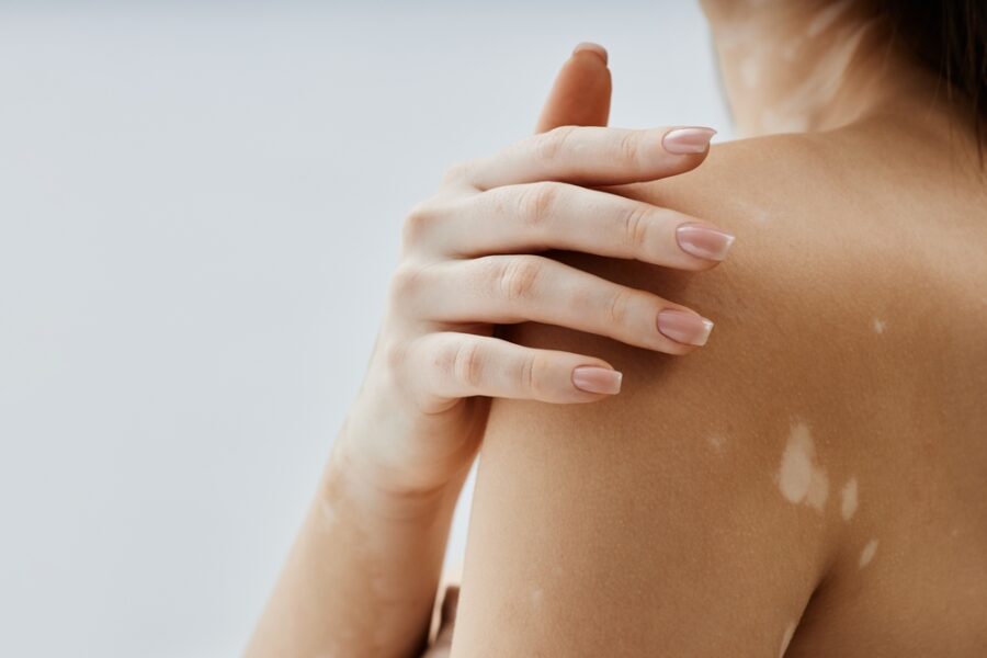 Is Vitiligo an autoimmune disease or a skin condition? Expert Dermatologist Explains