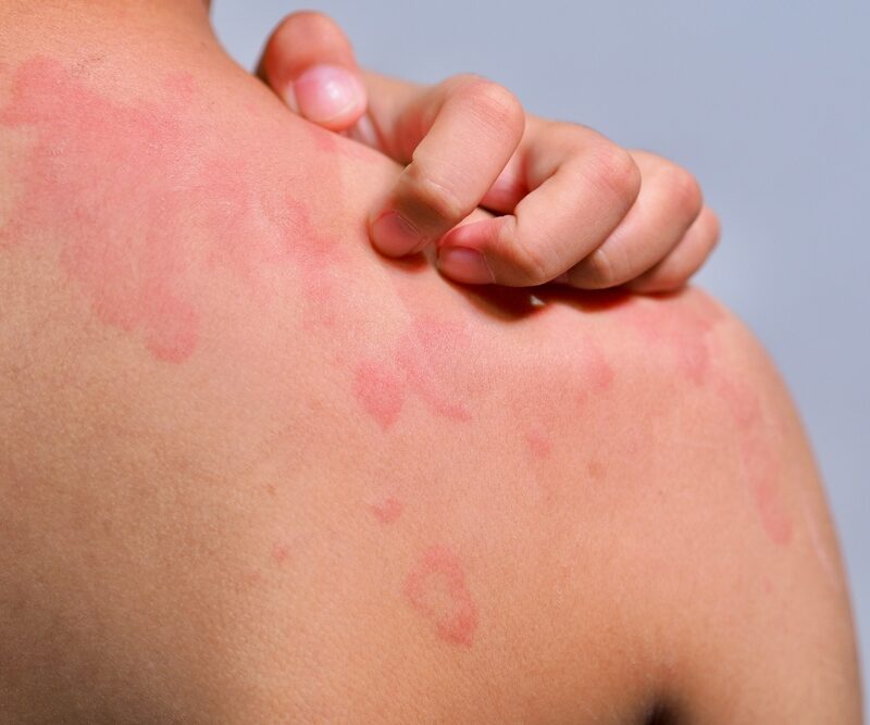 Can stress and anxiety actually trigger hives?