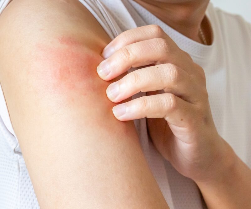 Can skin allergies be causing your unexplained rashes and itching?
