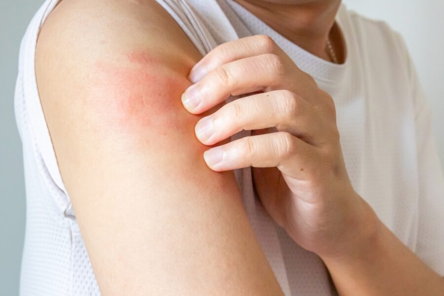 Can skin allergies be causing your unexplained rashes and itching?